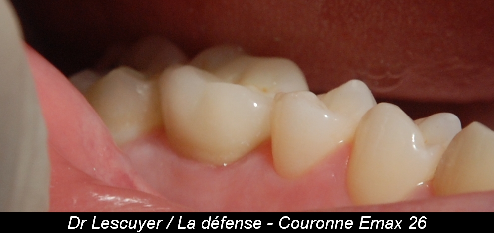 Mini vis Orthodontique La Défense (92800)  Dentiste Dr François Lescuyer  Chirurgien-Dentiste - La Défense