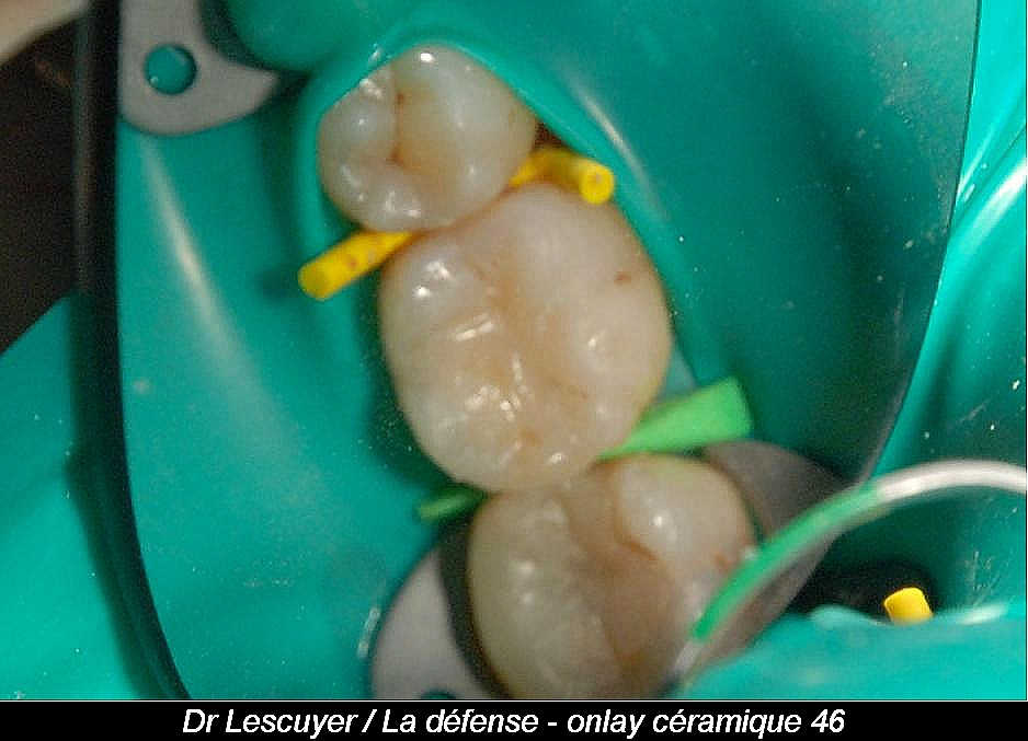 Digue dentaire La Défense (92800)  Dentiste Dr François Lescuyer  Chirurgien-Dentiste - La Défense