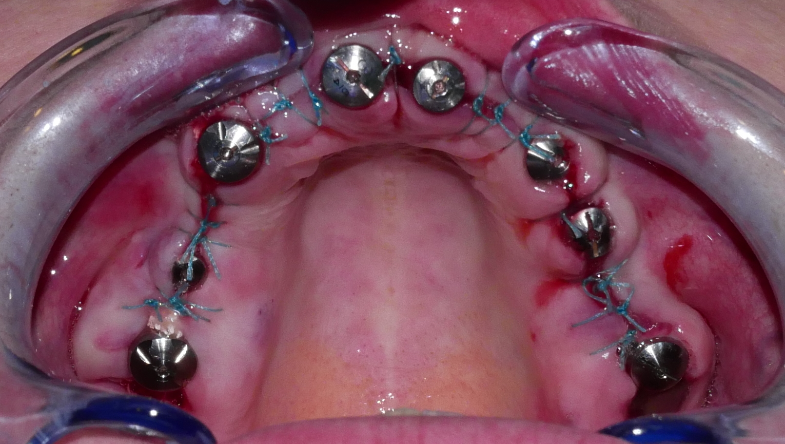 8 implants sont mis en place au maxillaire