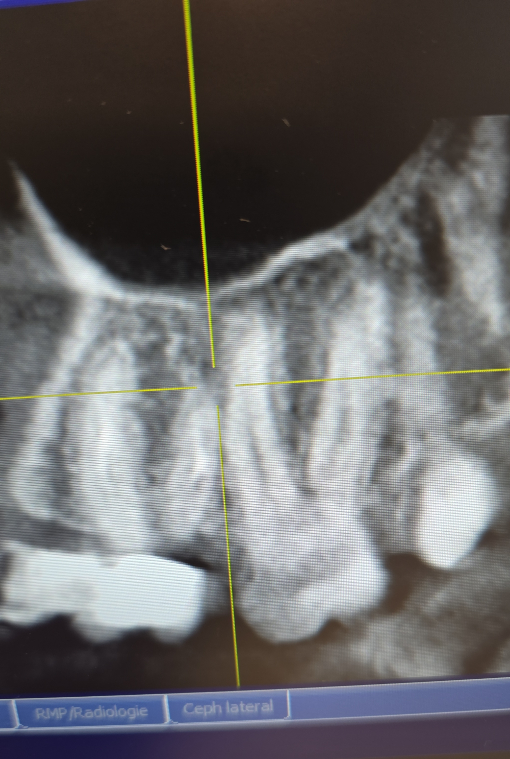 Dent nécrosée et biodentine