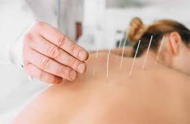 Acupuncture sur les méridiens